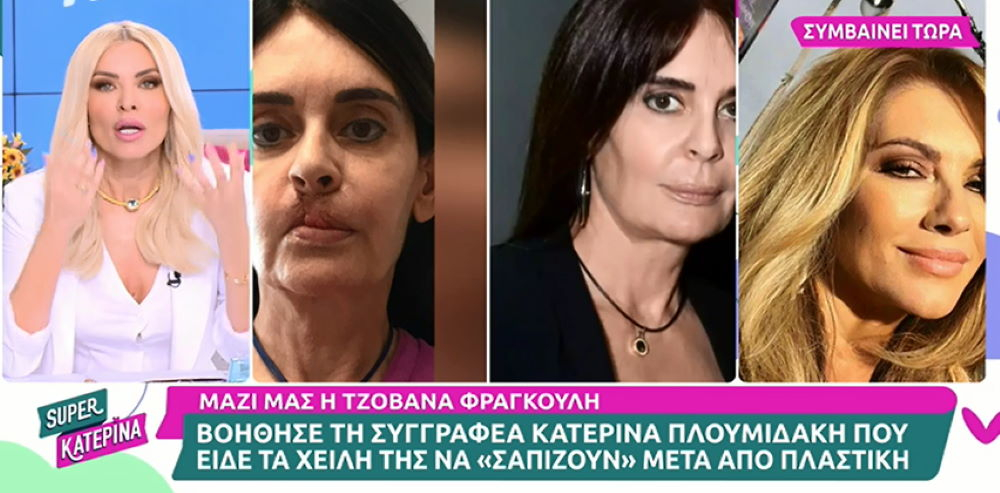 Τζοβάνα Φραγκούλη: Στέκεται δίπλα στην συγγραφέα, Κατερίνα Πλουμιδάκη, που γιατρός της «σάπισε» τα χείλη – «Έκανε πάνω της πείραμα. Πρέπει να του αφαιρεθεί η άδεια»