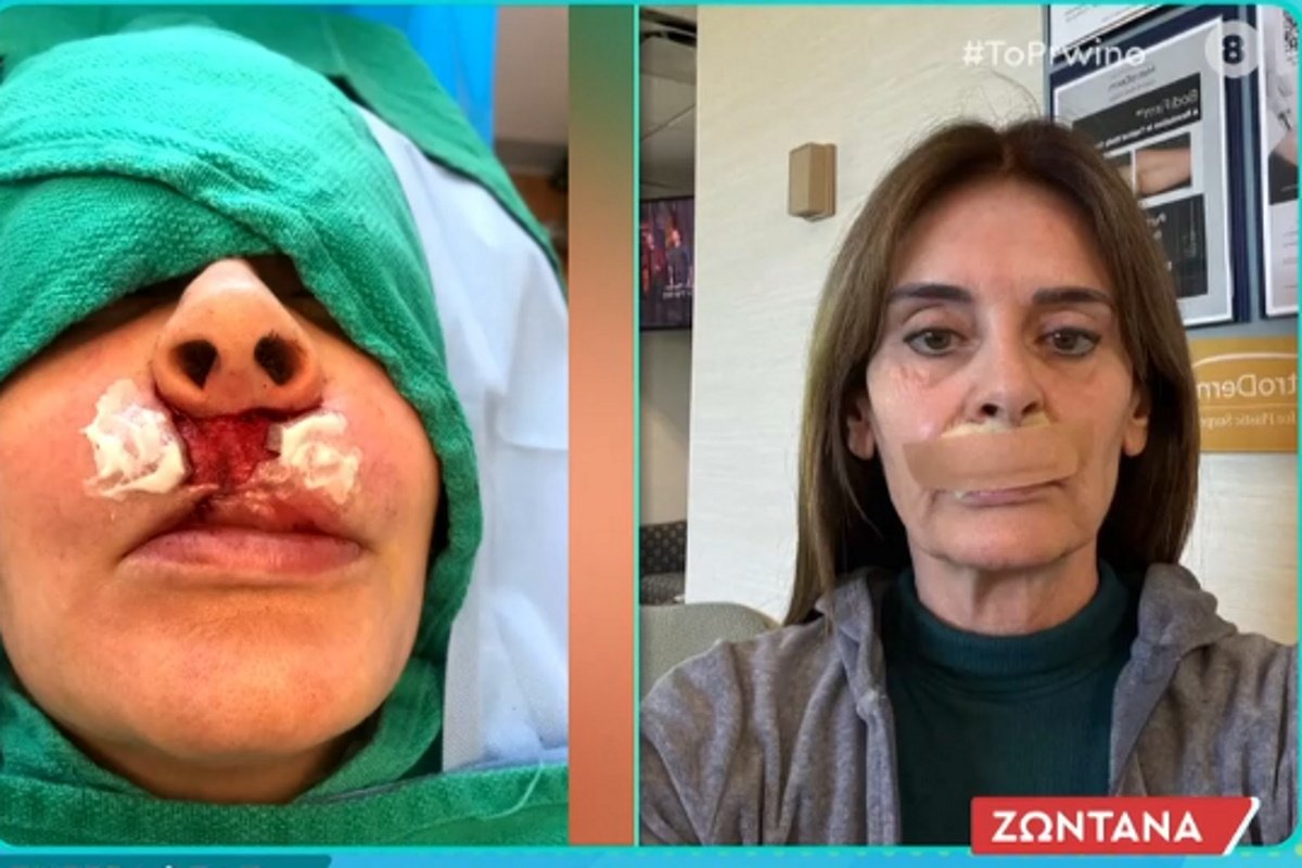 Σοκάρει η Κατερίνα Πλουμιδάκη: «Παίρνουν κάθε ενάμιση μήνα λίπος από τον γλουτό για να μου φτιάξουν τα χείλη»